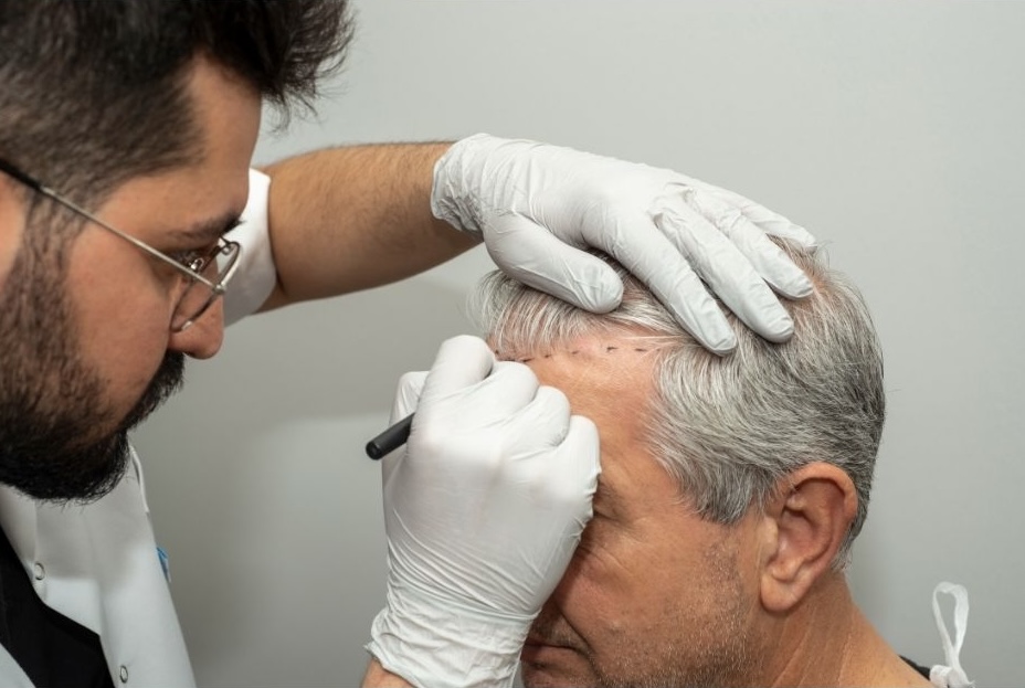 A doctor drawing a proposed hairline in surgical marker on the forehead of an older patient with grey hair.