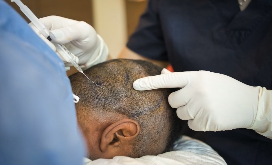 A clinician injecting local anaesthetic into a patient's scalp while a gloved hand marks the donor area at the back of the head.