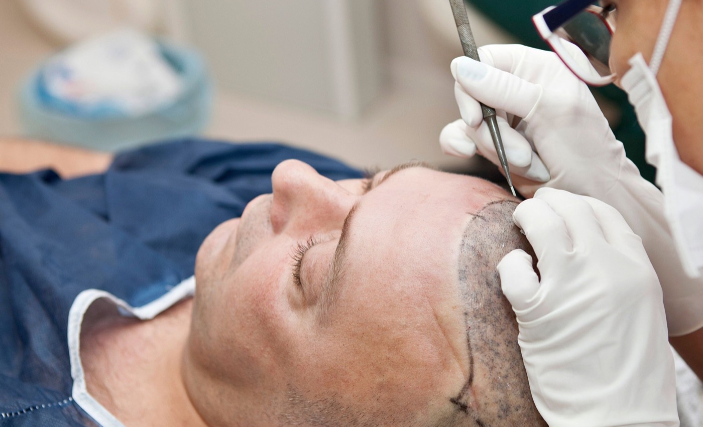 A clinician making tiny recipient incisions along a marked hairline on a patient's forehead.